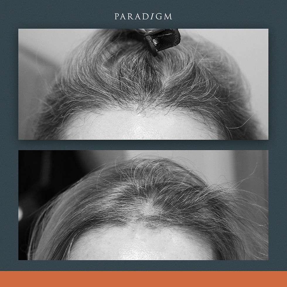 How do you repair a scar with a hair transplantation?