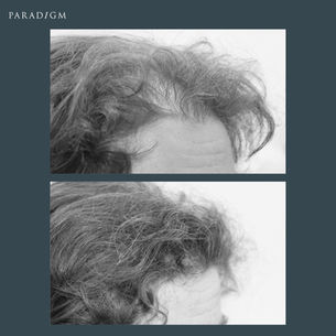Female Hair Transplants – Designed Around You