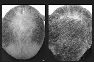 HAIR FOLLICLE CARE DURING THE GOFUE PROCEDURE.
