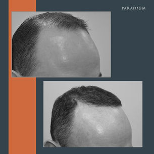 What to expect with a Paradigm Hair Transplant.