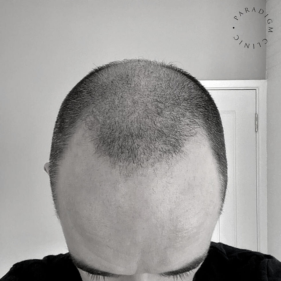 Hair Transplant After 4 Months