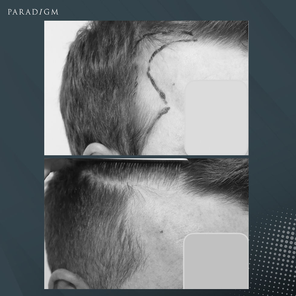 A hair transplant should be outstanding, and not stand out.