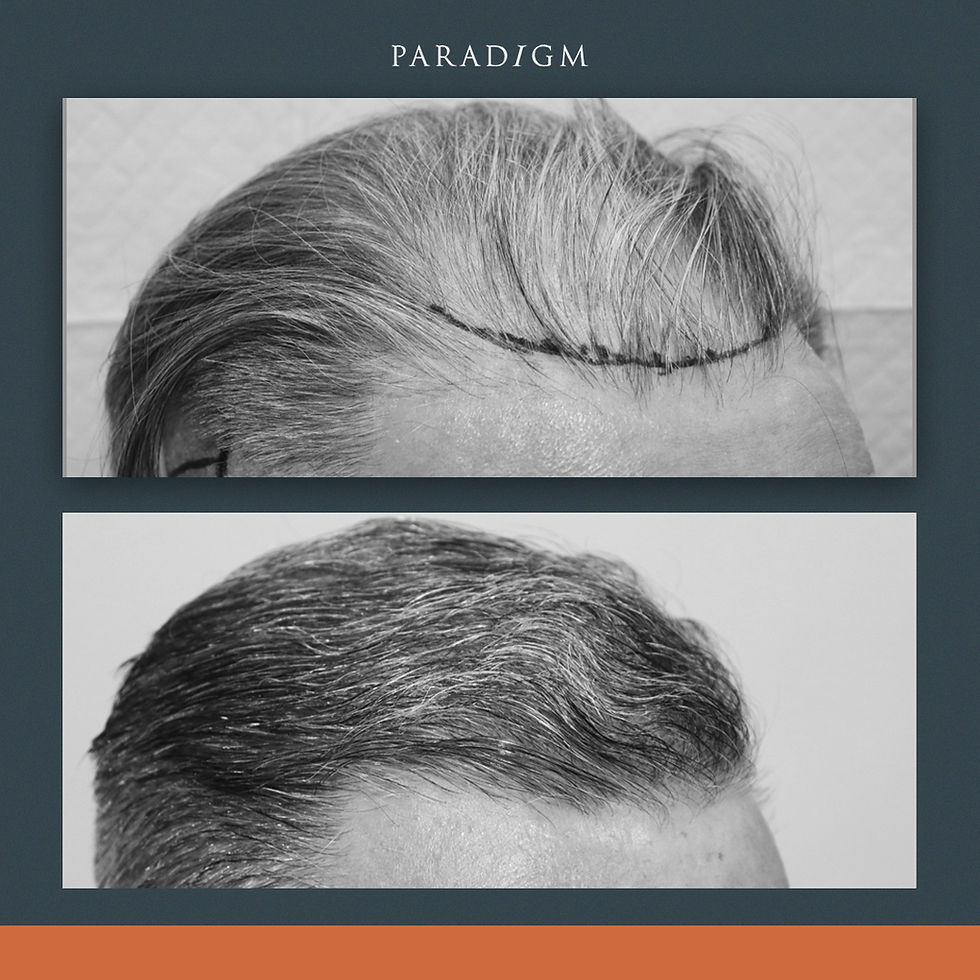 A forelock and full mid scalp transplant.