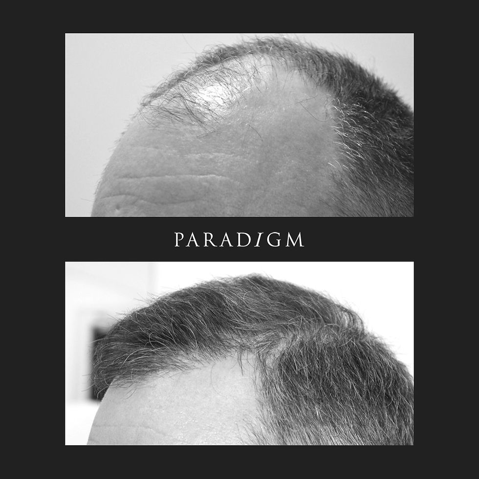 A hair transplant reduces the amount of scalp visible.