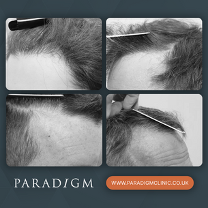 FOLLOW THE RULES OF HAIRLINE DESIGN FOR A NATURAL LOOK.