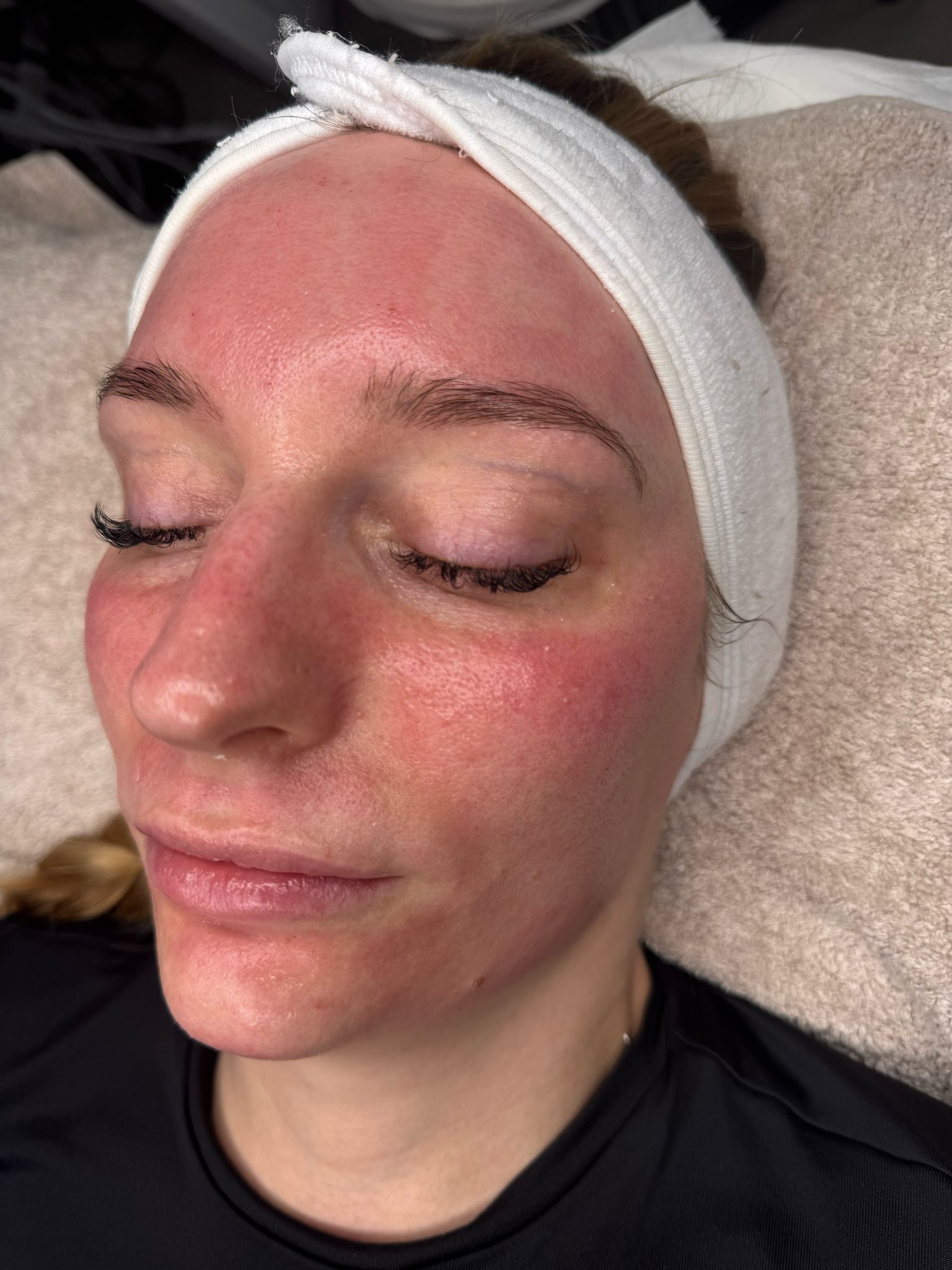 b12 injections and rosacea Strange Rash/ Low : r/B12_Deficiency Hydroxocobalamin: An Effective Treatment for