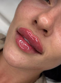 Hertford Cosmetics | Dermal Fillers