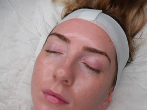 Top 5 Aesthetics Treatments in Hertford