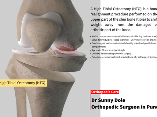 High Tibial Osteotomy (HTO): A Joint-Preserving Solution for Knee Pain | Article by Dr Sunny Dole Knee Surgeon in Pune