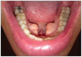 Oral Tori