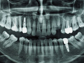 The Importance of Dental X-rays in Maintaining Optimal Oral Health