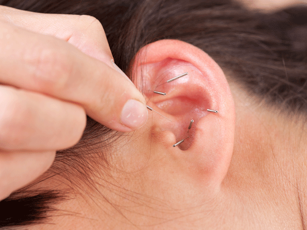 Auriculoterapia
