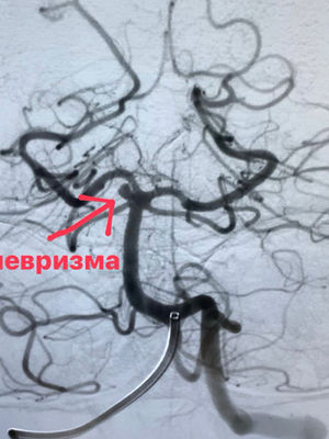 Аневризма судин головного мозку. Симптоми та статистика.