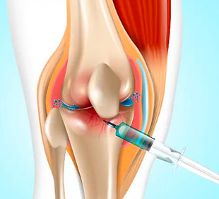 knee injection copyright free images - Google Search.jpeg