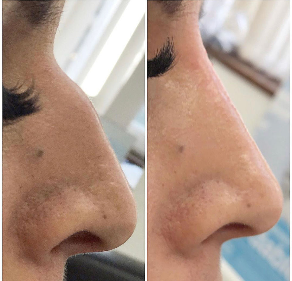Liquid Rhinoplasty