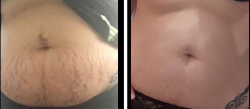 stretch marks.JPG
