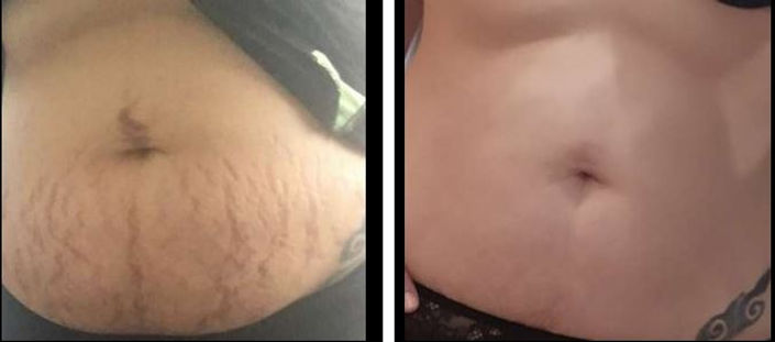 stretch marks.JPG