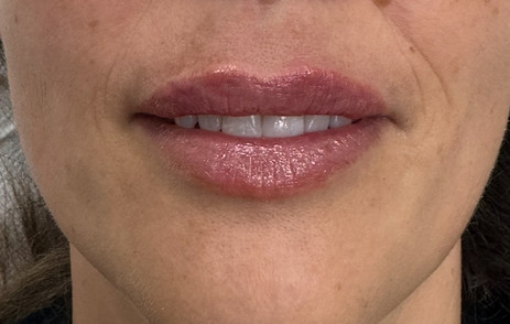 natural lip filler southampton