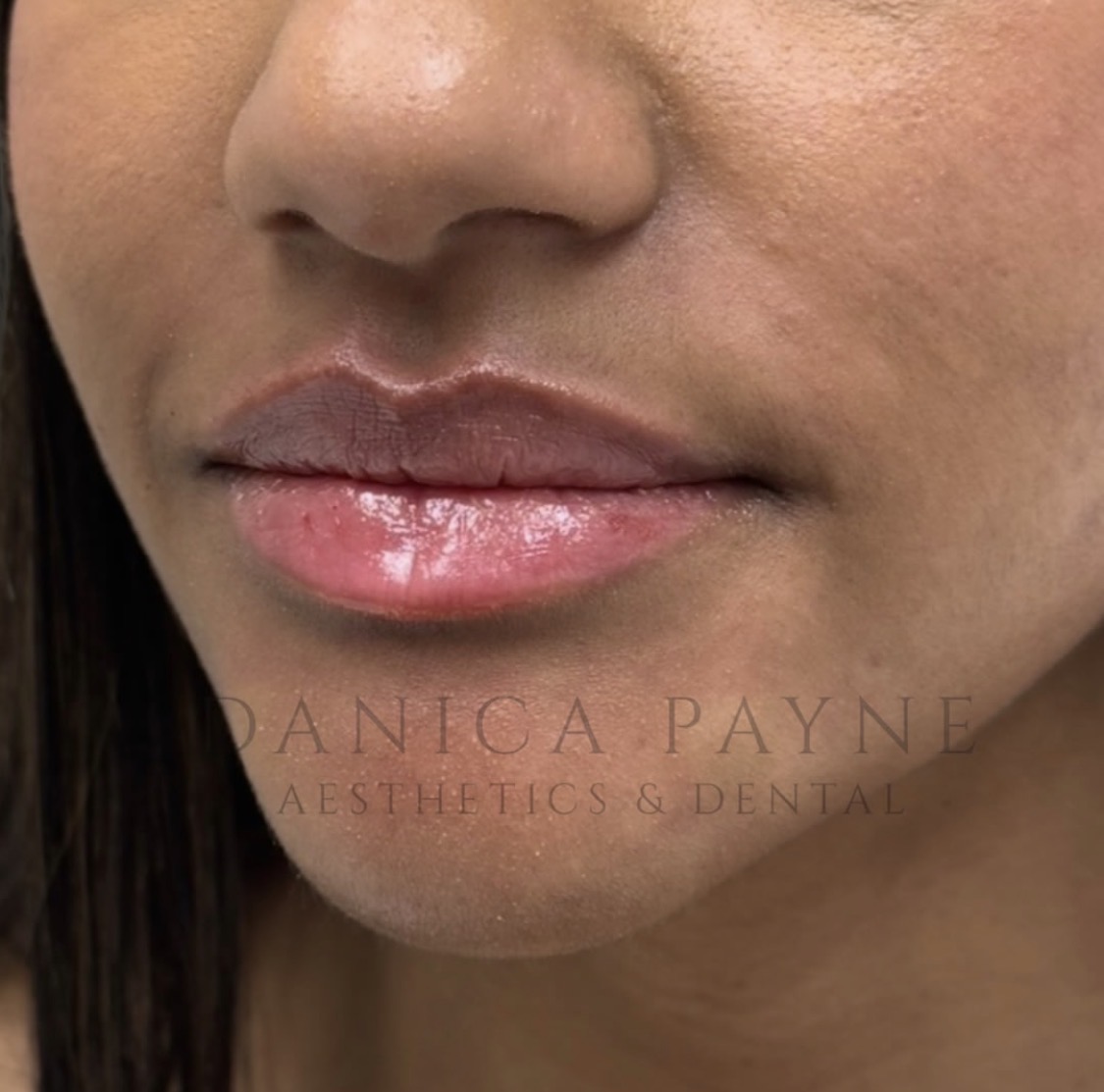 Signature Lip Filler — Before & After