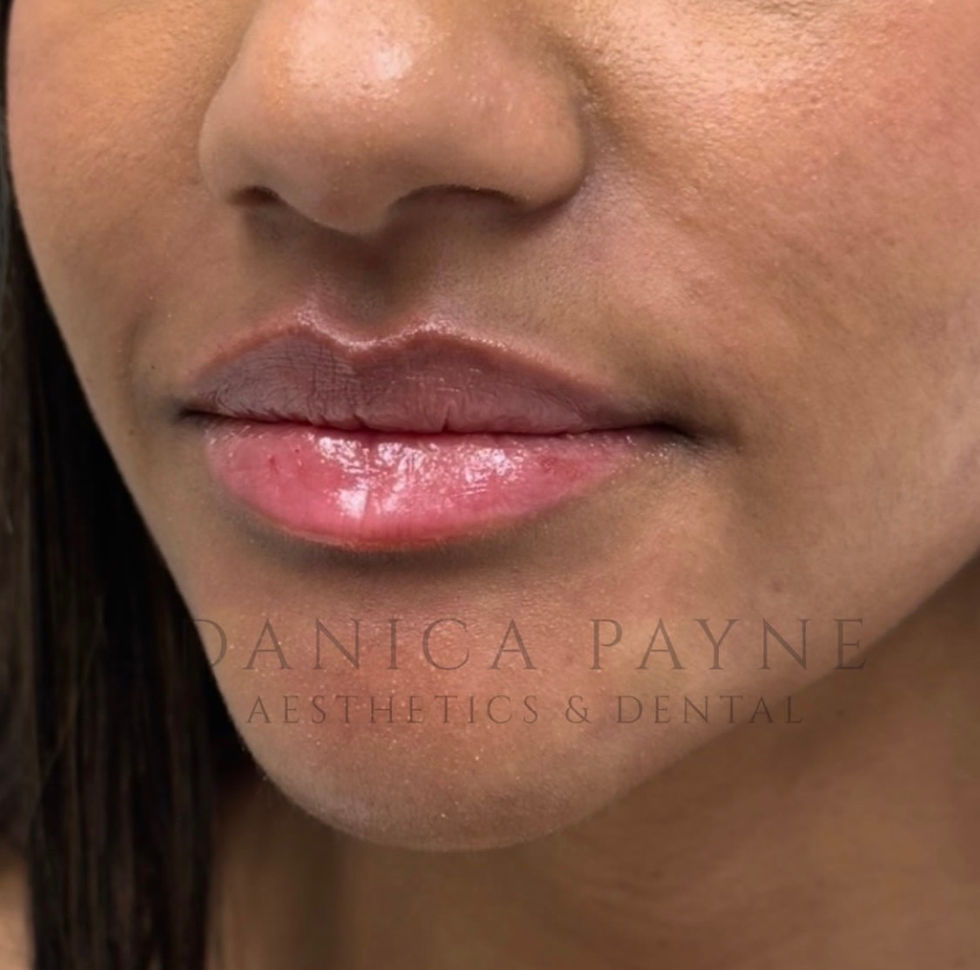 Signature Lip Filler