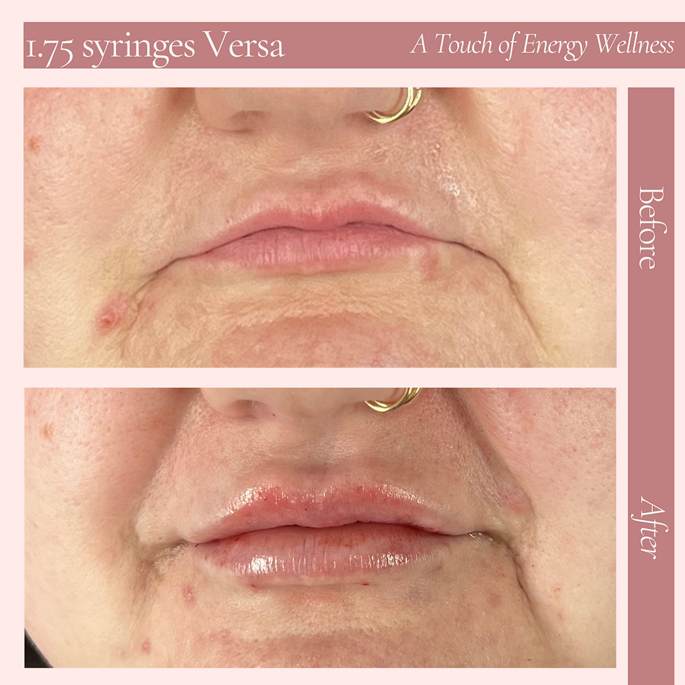 1 syringe of Revanesse Lips +