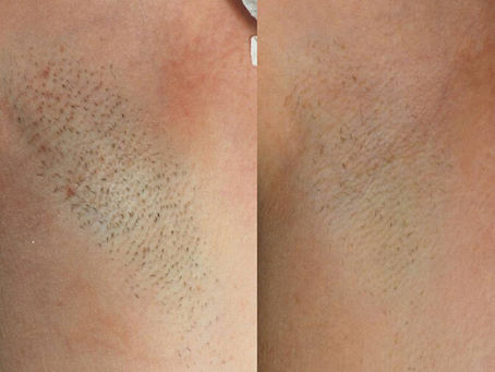 Hair removal season--how to prevent Folliculitis after hair removal