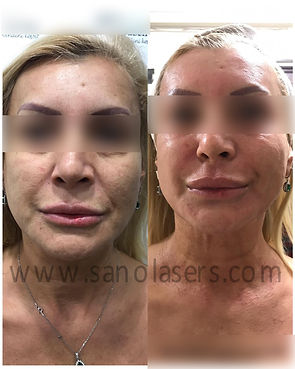 before and after microneedle