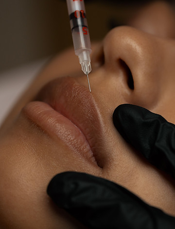 Woman receiving lip filler with a needle