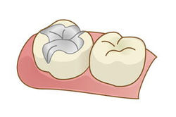 インレー（詰め物）