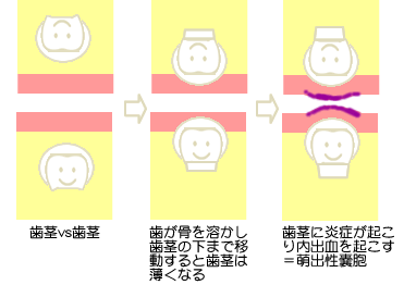萌出性嚢胞
