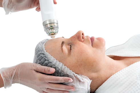 Secret RF fractional microneedling treatment improving wrinkles, scars, and skin texture