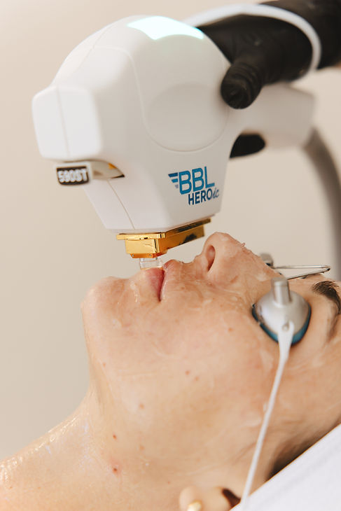 MOXI laser skin rejuvenation treatment for improving tone, texture, and early signs of aging