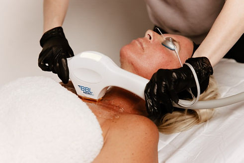 SkinTyte laser skin tightening treatment stimulating collagen for firmer skin
