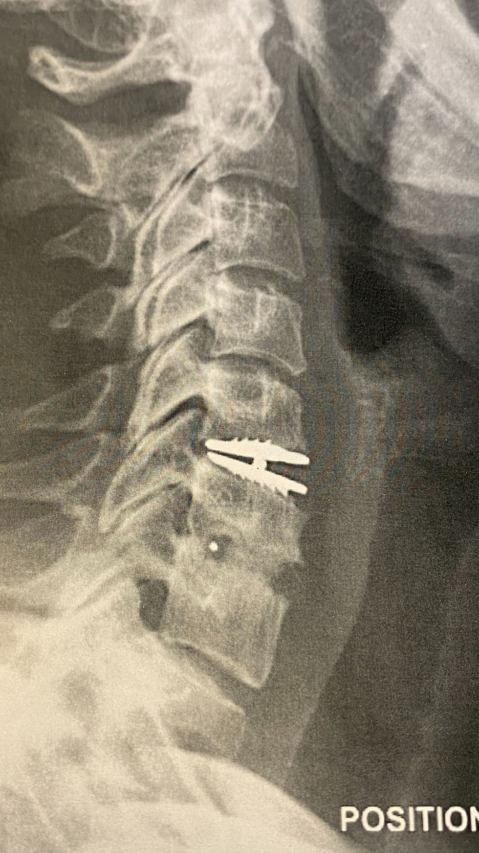 Hernie discale cervicale