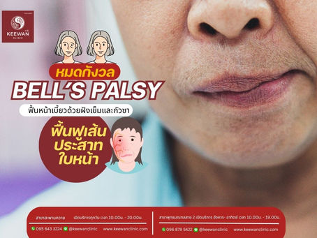 หมดกังวล Bell’s Palsy – ฟื้นหน้าเบี้ยวด้วยฝังเข็มและกัวซา ฟื้นฟูเส้นประสาทใบหน้า