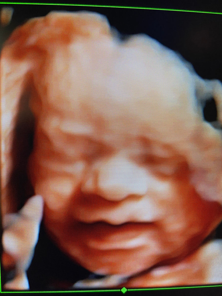 Sweet Pea Ultrasound