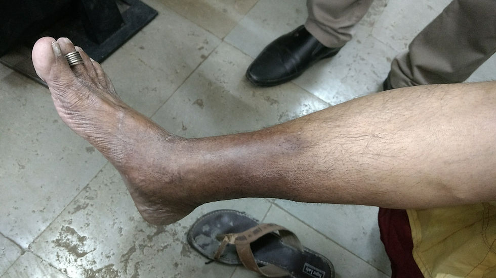 pigmentation CVI Dr ashish sarode