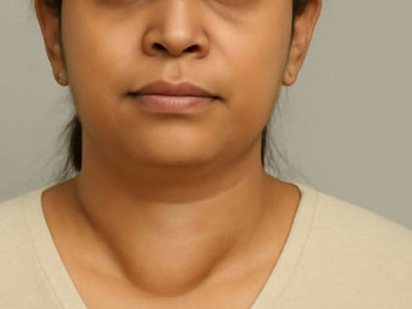 Thyroid nodule treatment by ethanol ablation