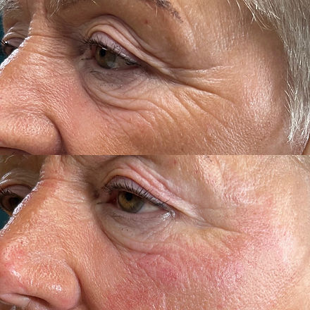 Electroporation Facial