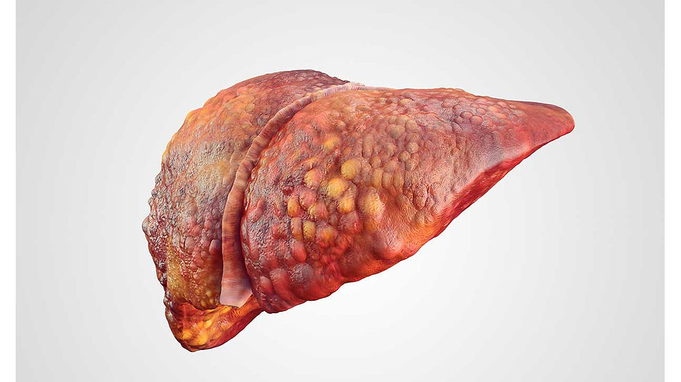 A picture of a damaged liver or liver cirrhosis, damaged liver, liver cancer, liver disease