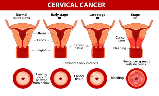 A longitudinal and cross section diagram showing cancer of the cervix, cervical cancer diagram