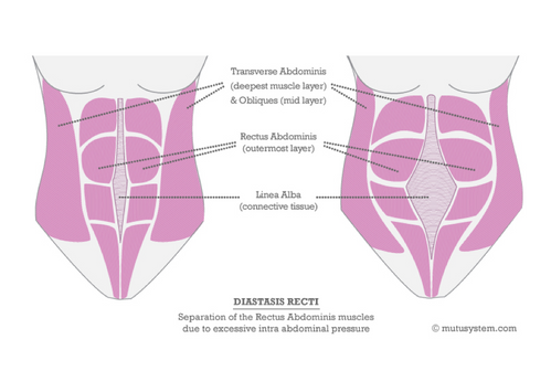 Rectus Abdominis Belly Wrap Diastasis Recti Linea Alba Belly