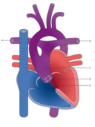 TRUNCUS ARTERIOSUS