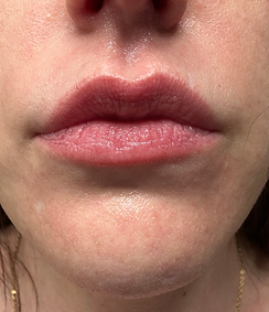 lip augmentation cincinnti