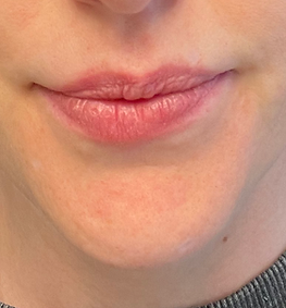 lip augmentation and enhancement