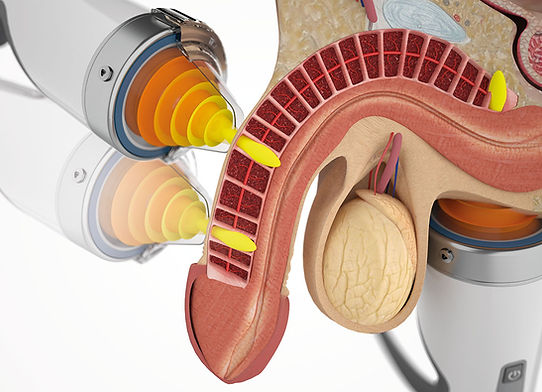 Focused Shockwave Therapy for improving erections, increase blood flow to the penis. Highams Park, Waltham Forest
