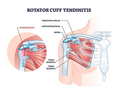 Rotator cuff injury tendonitis