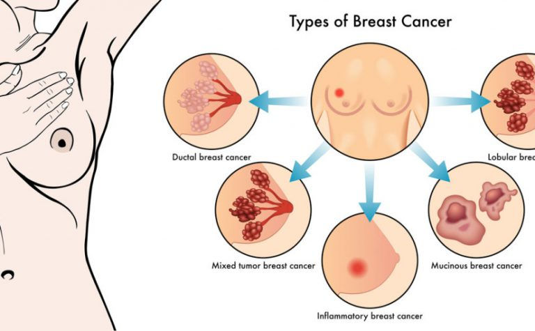 Breast-Cancer-Types-768x475.jpg