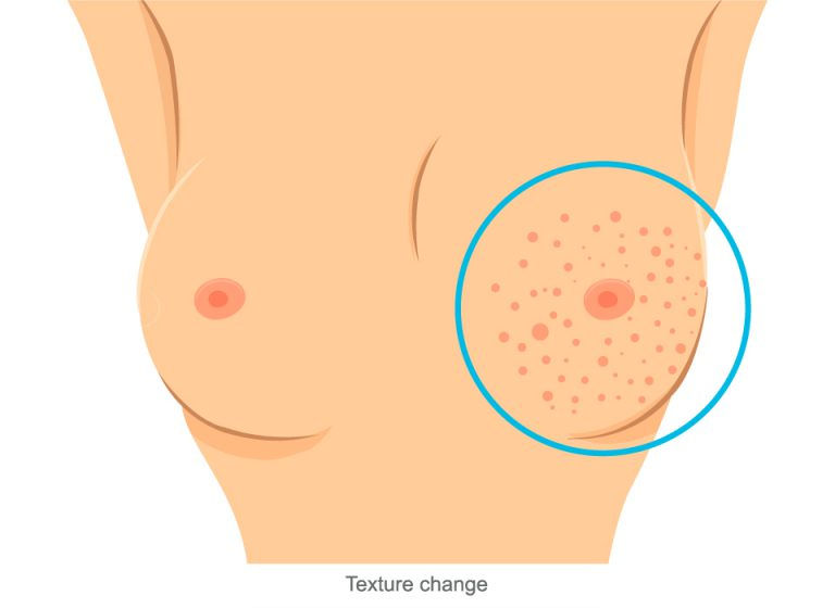 Breast-Cancer-Symptoms-768x560.jpg