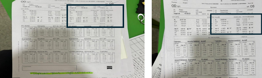 Fig 17 Preoperative(left image) and postoperative (right image) of the left eye of a patient. quickguide.org